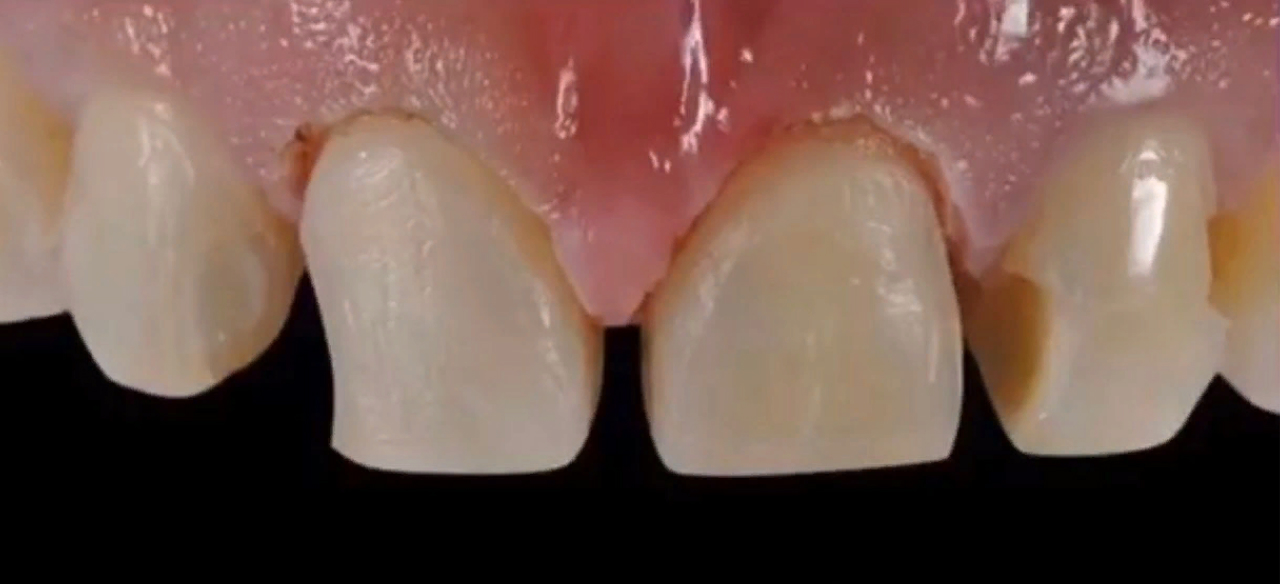 Как правильно хранить съемные зубные протезы?